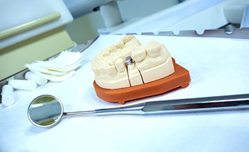 dental bridges 2