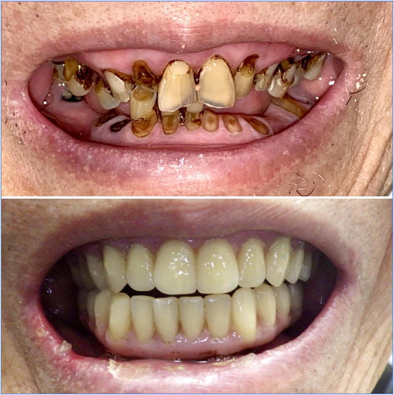All-on-X dental implants before and after showing a restored full-arch smile