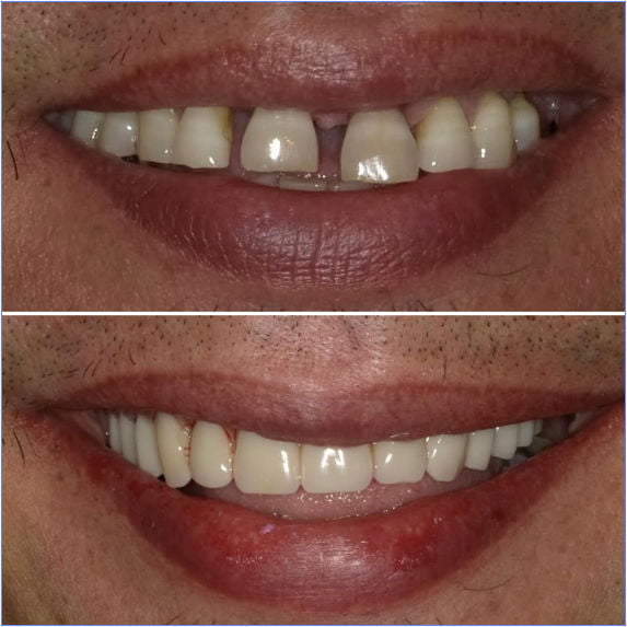 All-on-X dental implants before and after showing an improved full-arch smile