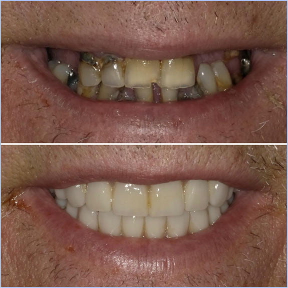 All-on-X dental implants before and after showing a restored full-arch smile