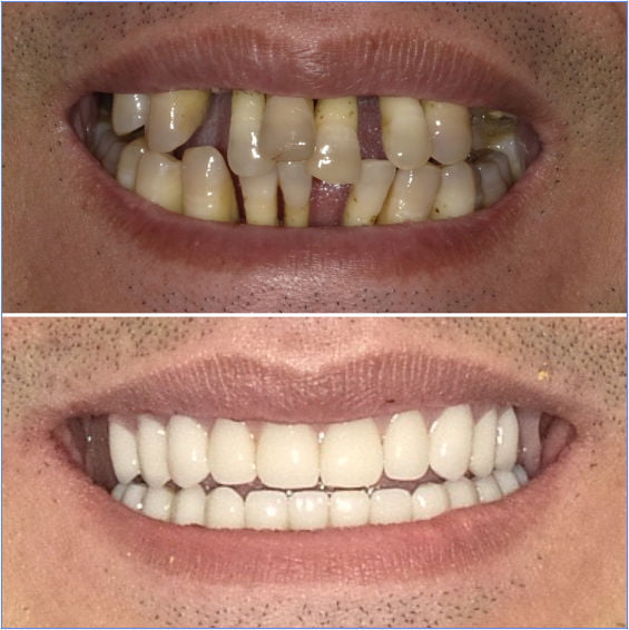 All-on-X dental implants before and after showing a restored full-arch smile