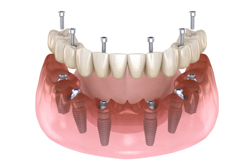 All-on-X dental implant system supporting a full-arch dental prosthesis