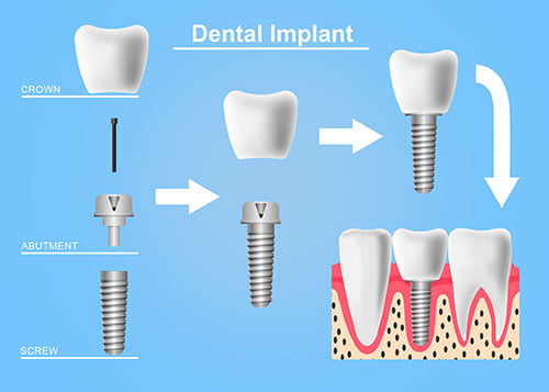 Diagram of dental implant components, including a titanium post, abutment, and crown for tooth replacement in Markham.
