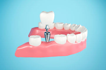 Close-up of a dental implant placed in the jawbone to replace a missing tooth in Markham.