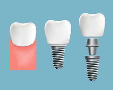 Illustration showing dental implant structure with a titanium post and crown used for permanent tooth replacement in Markham.