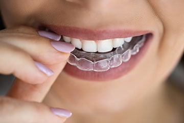 Close-up of a clear Invisalign aligner used for teeth straightening treatment in Markham.