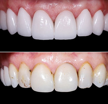 Custom lab-fabricated porcelain veneers are prepared for bonding during cosmetic dentistry treatment in Markham.