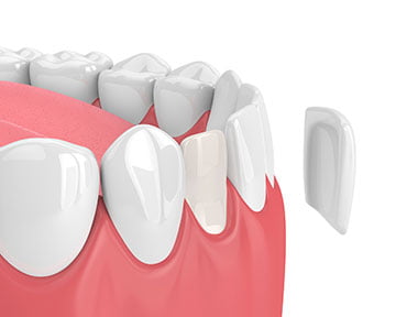 3D illustration of porcelain veneers bonded to front teeth, showing how veneer teeth improve colour, shape, and smile symmetry in Markham.