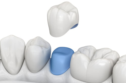 A dental bridge restoration replaces missing teeth as part of prosthodontic treatment.