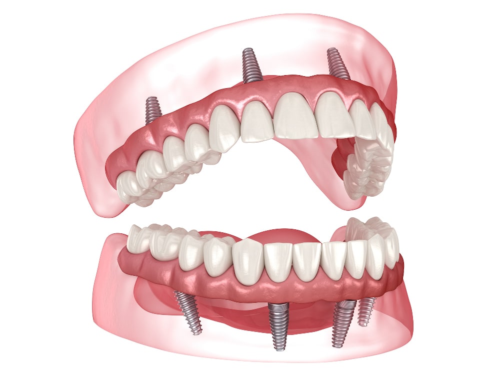 3D rendering of fa ull-arch dental prosthesis supported by All-on-4 implants