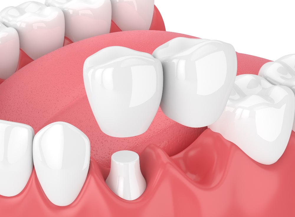 Cantilever dental bridge attached to a single tooth to replace a missing tooth in Markham