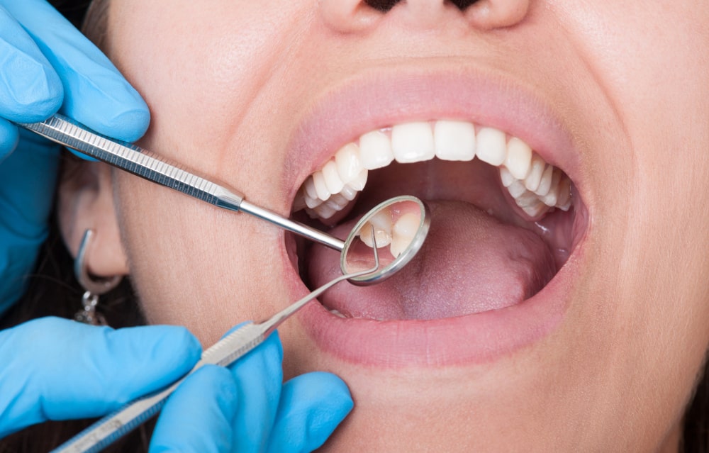 early signs of childhood tooth decay with white spots