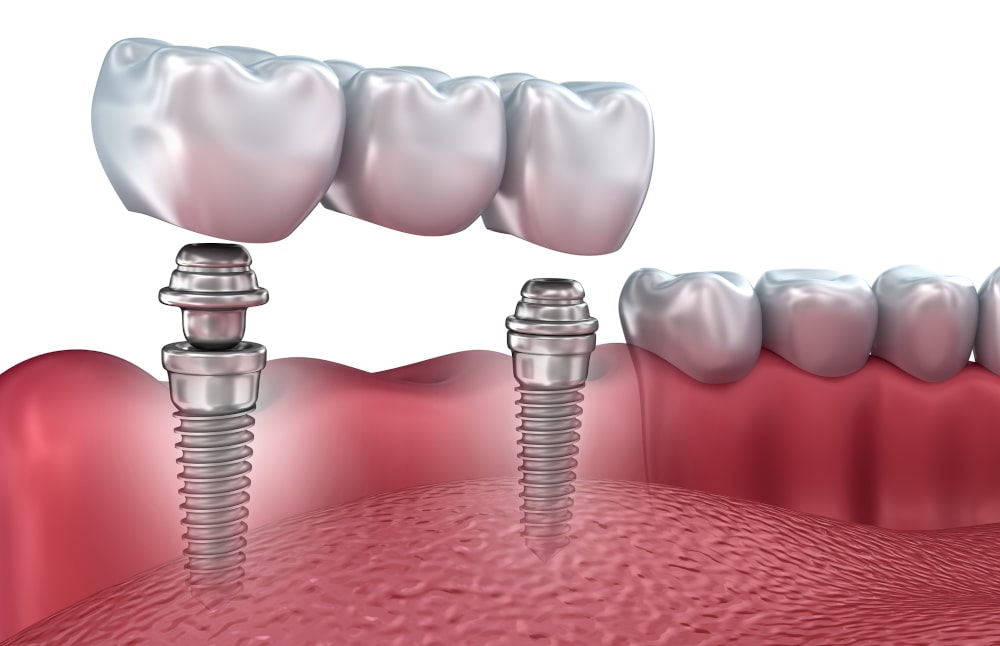 Implant-supported dental bridge with implants and pontics restoring multiple missing teeth in Markham