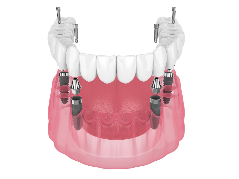 Close-up of mandibular prosthesis supported by four dental implants (All-on-4)