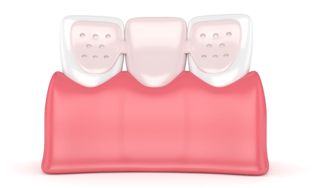 Maryland dental bridge bonded to neighbouring teeth to replace missing front teeth in Markham