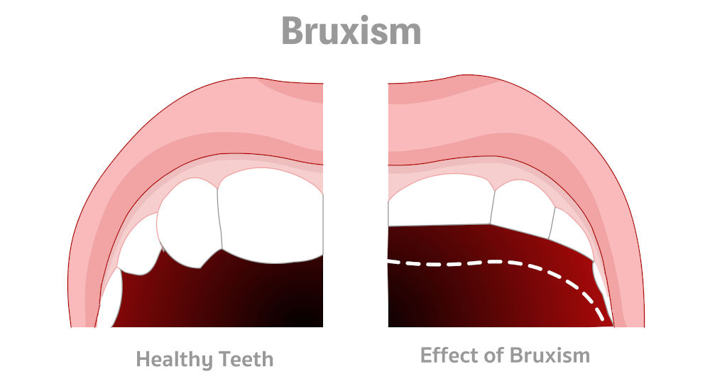 Illustration of teeth grinding (bruxism) showing jaw muscle tension and its potential impact on tinnitus through trigeminal nerve pathways.
