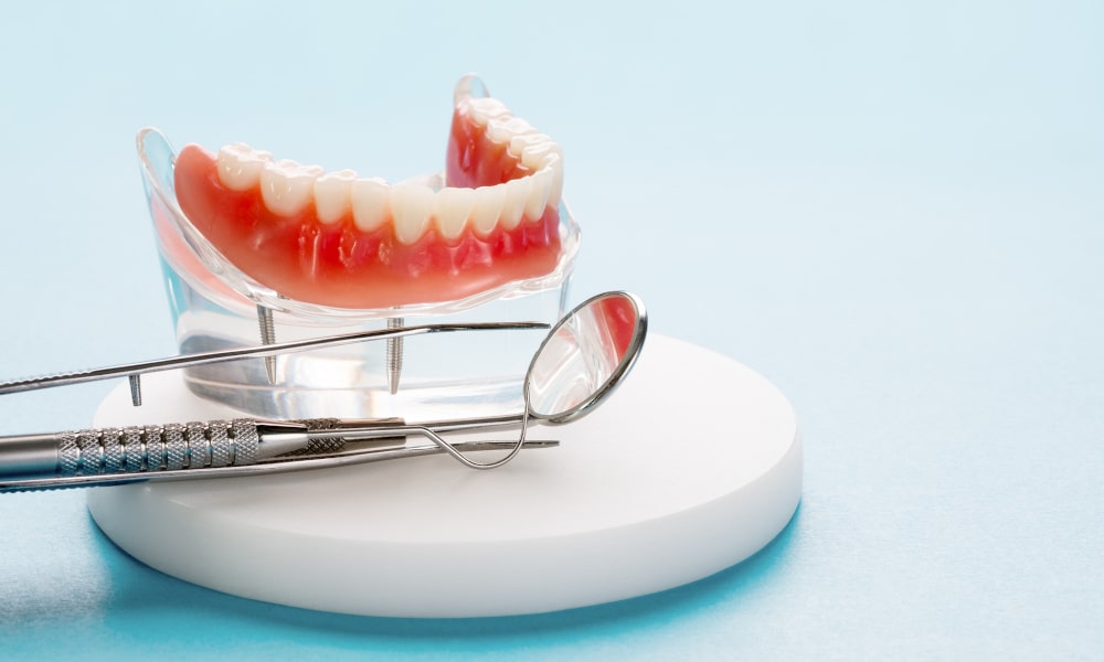 Traditional dental bridge model showing crowns and pontic for replacing missing teeth in Markham
