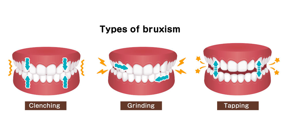 Diagram showing different types of bruxism and how chronic jaw clenching may contribute to somatosensory tinnitus.