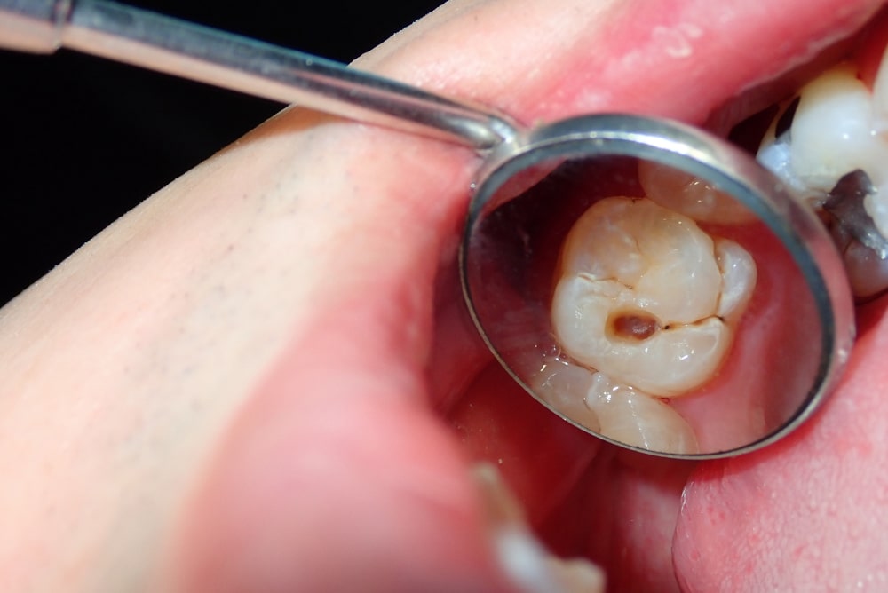 cavity in molar tooth caused by untreated dental caries